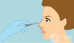 鼻翼不对称矫正需要多少钱？