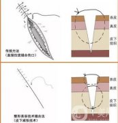 微针祛疤的原理，做多少次才有效