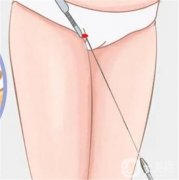 大腿抽脂是怎么做的？效果怎么样