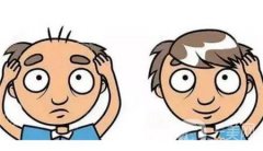 植发是移植哪里的毛囊