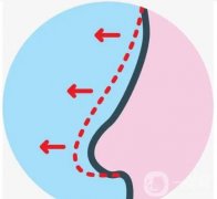 固体硅胶隆鼻的优点以及安全性如何