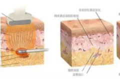 腹部抽脂后凹凸不平可以修复吗