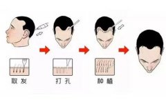 发际线过低如何调整