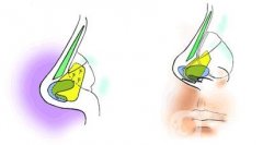 耳软骨垫鼻尖后容易去除吗