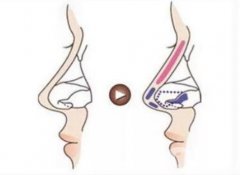 如何矫正鹰钩鼻，是怎么做的