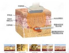 有哪些面部吸脂的方法