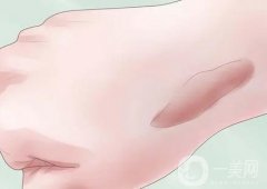 点阵激光祛疤需要多长时间才能见效