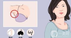 副乳切除术怎么做有利于恢复？