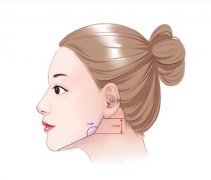 重庆磨骨整形价格