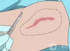 去除手术疤痕有哪些方法