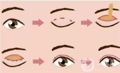 双眼皮手术后为什么会有疤痕