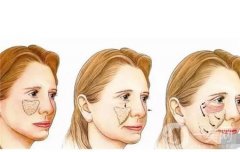 使用自体脂肪填充有什么好处？