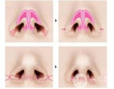 朝天鼻矫正后多久可以恢复