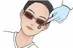 激光黑眼圈后的恢复期长吗