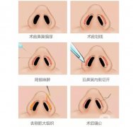 鼻孔缩小手术有哪些好处