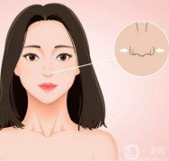 鼻孔缩小手术是否安全？是否有风险