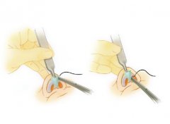 鼻尖矫正手术方法和步骤