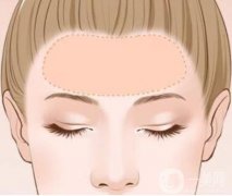 玻尿酸填充和自体脂肪填充的优点