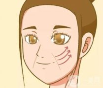 玻尿酸填充法令纹的优点