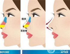 隆鼻修复后可能出现的问题或并发症