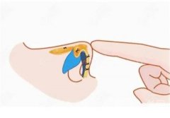 埋线减肥的禁忌和注意事项