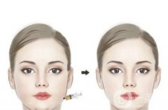 面部吸脂怎么样，适合哪些人