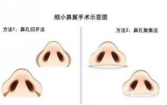 哪些情况下适合进行鼻孔缩小术