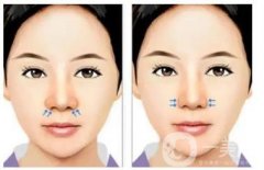 取出硅胶隆鼻假体的概率大不大