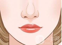 如何有效避免鼻整形修复带来的二次伤害？