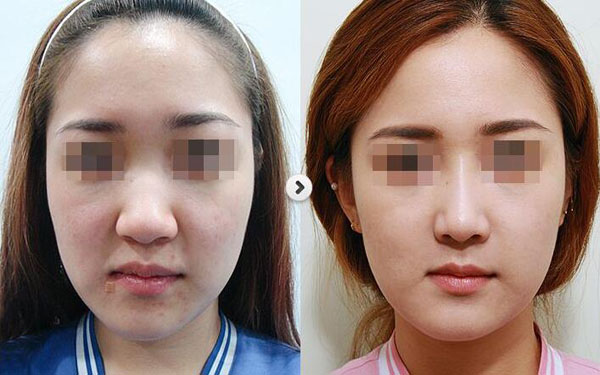 做鼻翼减薄调节效果怎么样?效果保持时间多久?
