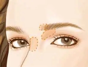 眼部吸脂术的特点、常用方法、适应症