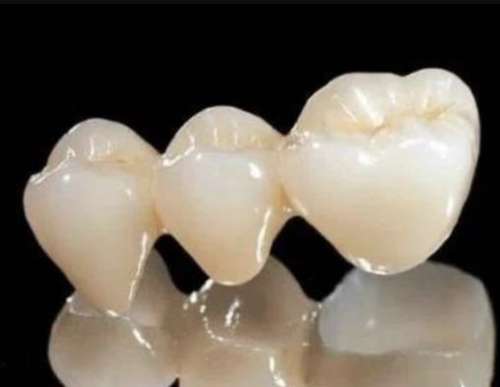 改变你的微笑：钛合金烤瓷牙的解决方案