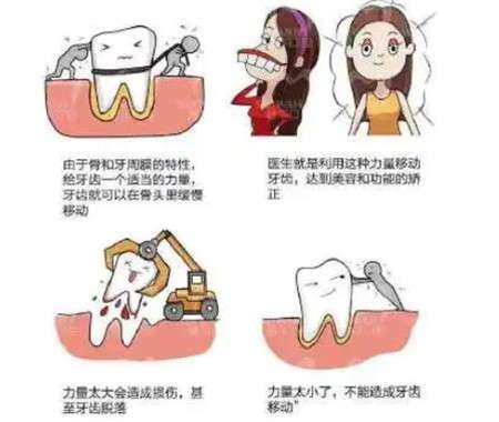 戴牙套会不会给牙齿带来负面影? 解你的疑虑