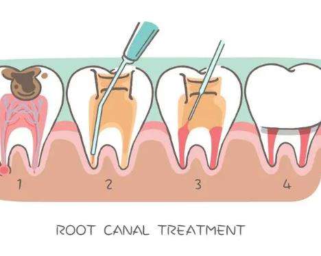 根管后牙齿严重脱落，如何有效防治？了解根管调节后牙齿脱落的修复方法