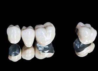 了解钛合金烤瓷牙价格趋势：找到优惠的牙齿修复选择