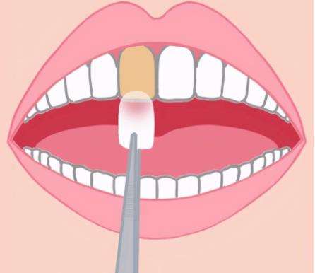 给牙齿贴面：美白牙齿的选择！看看牙齿贴面的优点
