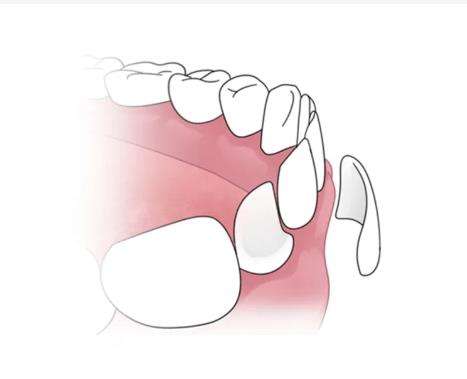 氟斑牙自我改良的有效方法大揭秘！看看哪两种两种方法实现？