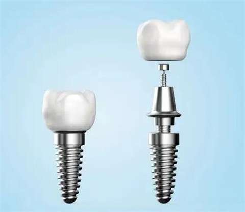 做种植牙的人都太傻了？关于种牙的这些常见问题解答