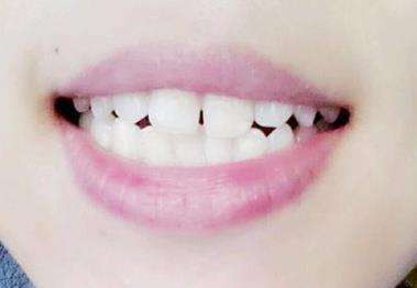 门牙缝隙大做牙齿贴面会不会不美观