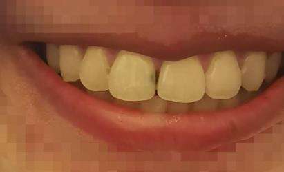 门牙缝大被骗做贴面怎么办？贴面需要注意些什么?