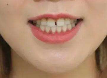 门牙缝隙大带牙套多少钱？