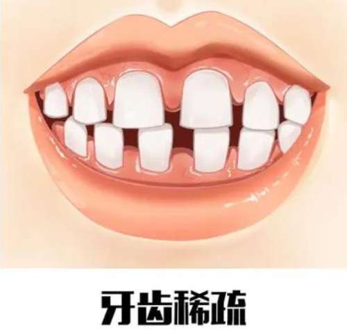 牙缝过大的调节方法和费用