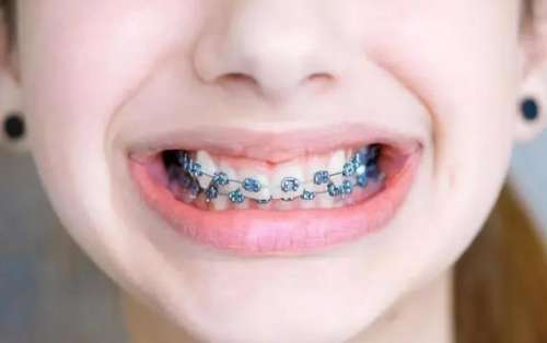 成年人进行矫正牙齿的佳年龄是多大？