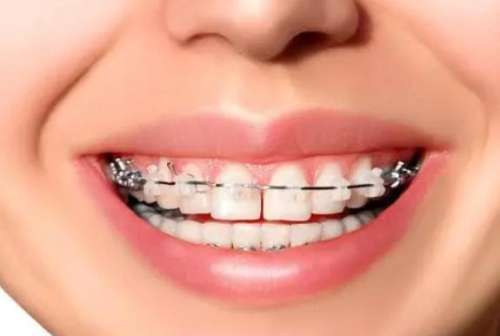 矫正牙缝收紧要多少钱？具体费用范围一览