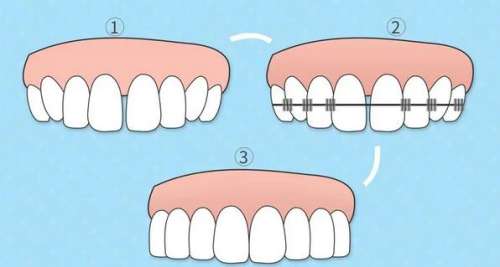 矫正牙齿的疼痛程度和不同调节方式的比较