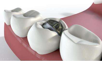 门牙补牙后一般能维持几年？