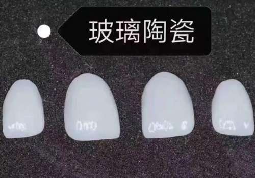 烤瓷贴面多少钱一颗？烤瓷贴面价格范围及选择建议