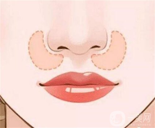 天津伊美尔熊斌鼻部手术+自体脂肪面部填充恢复果*满意！