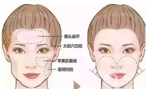 天津伊美尔于广洋主任做了自体脂肪全脸填充，拯救干瘪的脸