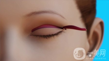 去除眼袋的方法：溶脂去眼袋